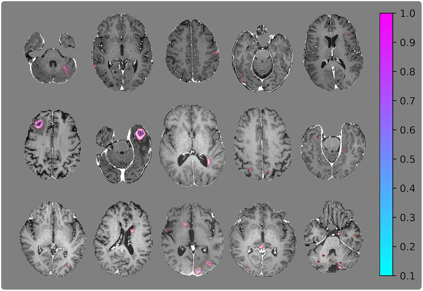 Representative brain metastasis segmentation examples showing ground truth annotations and model probability maps across a challenging 153-metastasis case