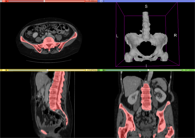 CT viewer showing axial, sagittal, and coronal cross-sections plus a 3D volume render, with multi-organ and skeletal segmentation overlaid in pink