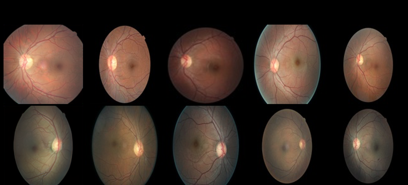 Grid of retinal fundus photographs comparing GAN-generated (700k-epoch) synthetic images against real diabetic-retinopathy images, illustrating the realism of the synthetic fundus images