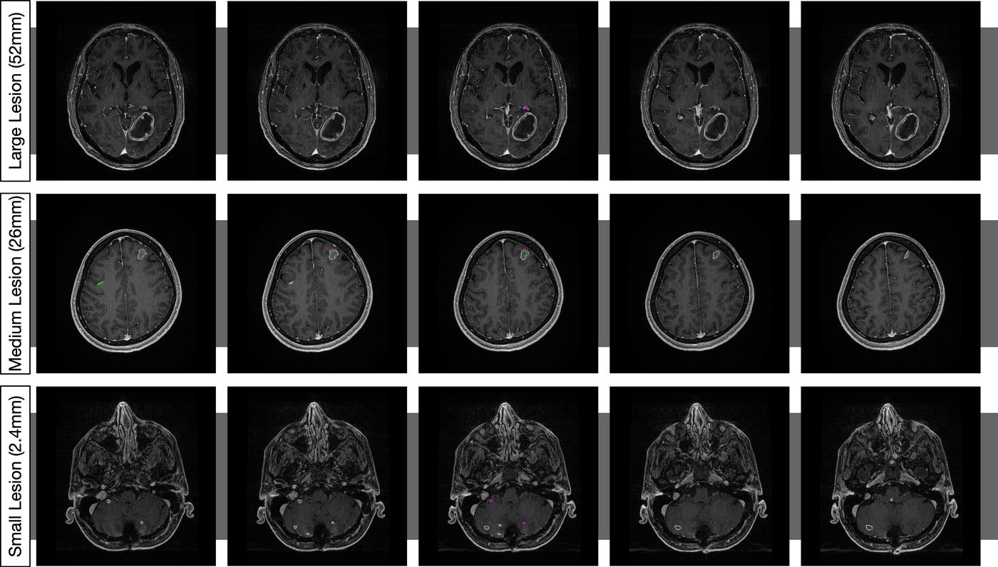 Segmentation results from the lopsided-bootstrap robust network across large (52mm), medium (26mm), and small (2.4mm) metastases, with green ground-truth and magenta prediction contours on brain MRI slices
